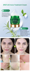 Anti Acne Face Cream